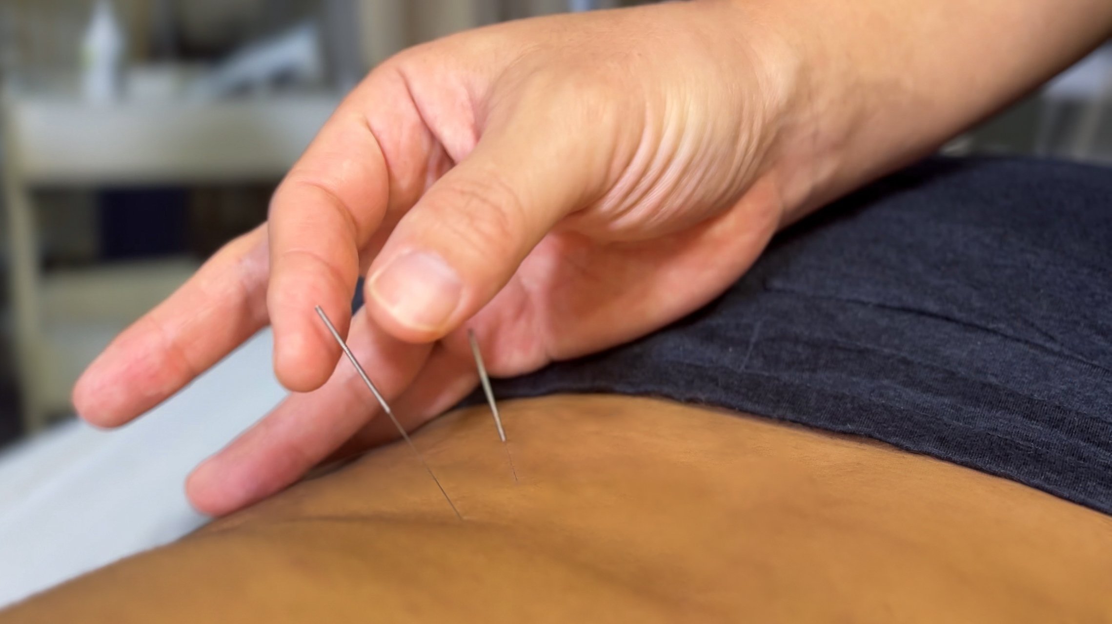 Acupuncture treatment session